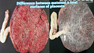 Difference between maternal amp fetal surfaces of placenta in hindihow to identify them placenta [upl. by Ellicul]