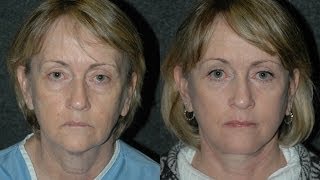 Facelift Surgery Before and After and Eyelid Lift on 60 Year Old Woman facelift [upl. by Venola]