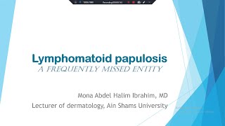 6 Lymphomatoid Papulosis  A Frequently Missed Entity [upl. by Nickola]