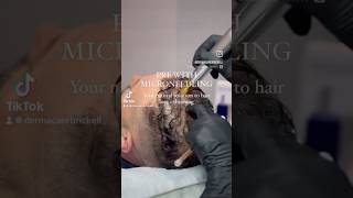 PRF with Microneedling for Male Hair Growth  Hair Loss Solution at Dermacare Brickell shorts prf [upl. by Neelahtak]