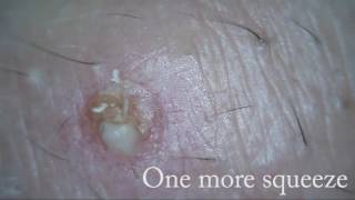 Big white pimple popping under a scab [upl. by Domenico]