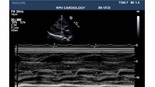 LVOT Obstruction [upl. by Nidraj429]