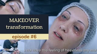 EYE LIFT PLEXR Makeover transformation Ep 6 [upl. by Ackerman]