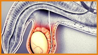 Hydrocele vs Varicocele vs Torsion vs Epididymitis vs Tumor [upl. by Avenej]