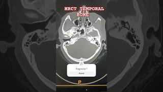 HRCT TEMPORAL BONE  TM JOINT  MASTOID  EAR 👂 radiology ctscan ear hemantkushwah3453 [upl. by Weinreb]