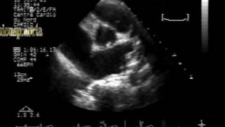 bicuspid aortic valve 2 with mild stenosis and regurgitation [upl. by Shipman629]