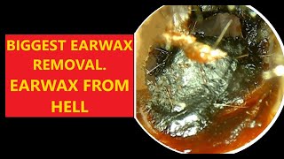 BIGGEST EARWAX REMOVALLarge Ear Wax Removal From Both Ears 20231123 relaxing satisfying asmr [upl. by Maloney417]