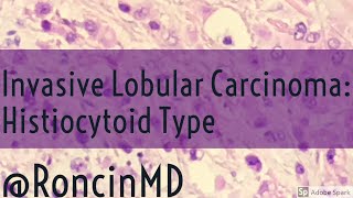 Histopathology Breast Ductal carcinoma [upl. by Melitta]