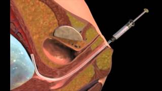 Chorionic Villus Sampling [upl. by Anial574]