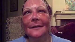 FAT TRANSFER BLEPHAROPLASTY PLASMA DIARY IN DALLAS TEXAS [upl. by Notyal]