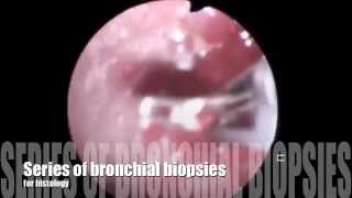 bronchial biopsy [upl. by Kcirtap]