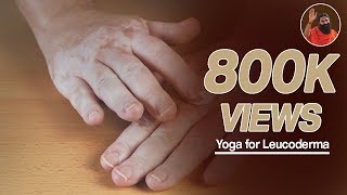 Yoga for leucoderma सफेद दाग  Swami Ramdev Part 1 [upl. by Behre340]