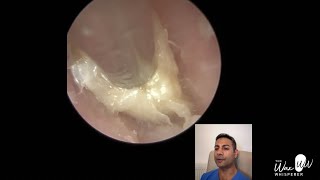 1527  Dead Skin Plug Extracted from Ear [upl. by Grishilde]