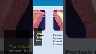 Painless Pulmonary Vein Isolation Your Ultimate Guide to Atrial Fibrillation Ablation [upl. by Steinway438]