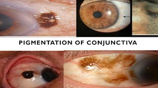 PIGMENTATIONS OF CONJUNCTIVA  Are they cancerous [upl. by Adniled262]