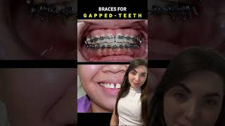 Fechamento de diastema com aparelho metálico 😱 [upl. by Peggie]