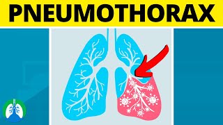 Pneumothorax Medical Definition  Quick Explainer Video [upl. by Ocker]