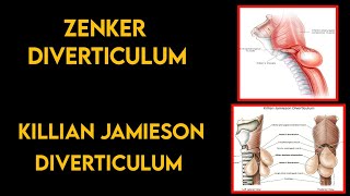 esophageal diverticula  Zenkers diverticulum and Killian Jamieson diverticulum  diagnosis [upl. by Gennifer]