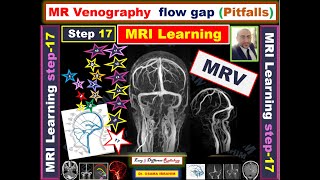 MRV Flow GAP pitfalls Venous sinus thrombosis versus hypoplasia MRI learning Episode 17 [upl. by Cooke]