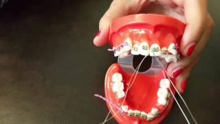 Placing a stainless steel ligature wire for Braces [upl. by Ecirum534]