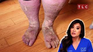 Sandra’s Fight Between Life and Death  Dr Pimple Popper  TLC [upl. by Pudendas]