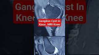 Ganglion Cyst In KneeMRI KneeDr Sai Chandraganglioncystknee aclmri mriknee [upl. by Mendes]