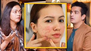 Girls Pimples Kaise Hataye  PCOS amp Skin Treatment Hindi Doctor Explanation [upl. by Lobiv71]