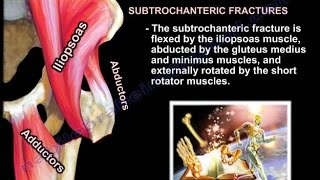 Femur fracture Subtrochanteric fracture  Everything You Need To Know  Dr Nabil Ebraheim [upl. by Pyotr]