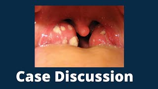 Case Discussion  Acute Tonsillitis [upl. by Aylat858]