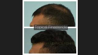 Dallas Topical Finasteride Before and After [upl. by Engen]