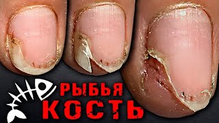 Рыбья КОСТЬ в НОГТЕ🆘😱 ГНОЙПустота под ногтем СЮРПРИЗ под ГЕЛЬЛАКОМТРЕШ маникюрПРОТЕЗИРОВАНИЕ [upl. by Rodrich]