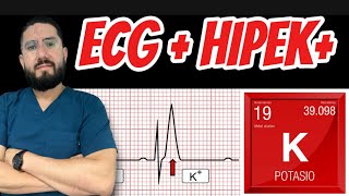 Electrocardiograma en Hipekalemia 🫀 [upl. by Gonzales]