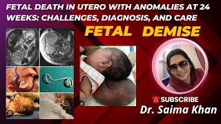 Fetal Death in Utero with Anomalies at 24 Weeks Challenges Diagnosis and Care drsaima khan case [upl. by Shurwood]