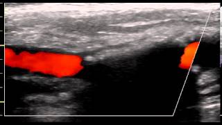 INTERNAL CAROTID ARTERY CALCIFIC PLAQUE [upl. by Cilka]