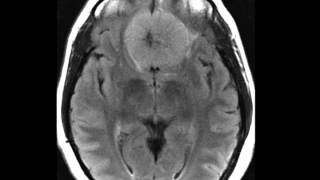 Meningioma Planum Sphenoidale [upl. by Gan]