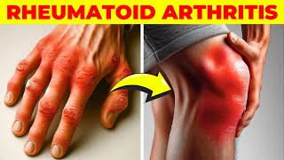 Arthritis  Symptoms Causes Types Treatment amp Prevention [upl. by Dianne59]