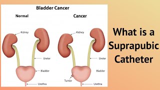 What is a Suprapubic Catheter [upl. by Toms]