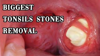 biggest tonsils stones removal tonsilolith hidden huge tonsils stones removal [upl. by Ymmik]