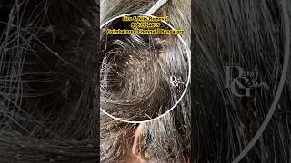 Lice removallice treatment in parlourhow to treat lice amp nitslicelice nits removal in Chennai [upl. by Helbonia495]