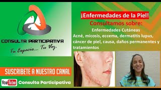 Lupus y Cáncer de piel Acné Micosis Dermatitis Eccema causas y tratamientos Consulta P 291024 [upl. by Richmond]