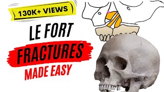 Le Fort fractures  PART ONE [upl. by Naie]