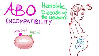 ABO Incompatibility  Hemolytic Disease Of The Newborn HDN  Hematology amp Pathology [upl. by Arty]