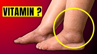 1 Vitamin to Eliminate Swelling in Feet and Legs  HealthQuest [upl. by Scot]