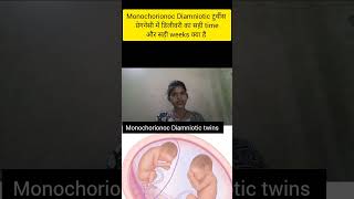 monochorionoc Diamniotic twins pregnancy me delivery ka sahi time kya hota h shortstwinsdelivery [upl. by Ahsac]