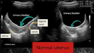 Normal Uterus and Ovaries  Ultrasound Case [upl. by Melas]