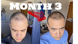 3 Months After My FUE Hair Transplant in Turkey  4550 Grafts  Cinik Clinic [upl. by Arayc]