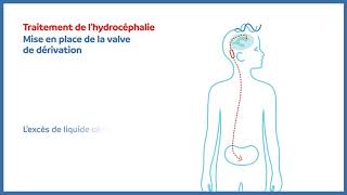 Hydrocéphalie  valve de dérivation peritonéale [upl. by Tavey]