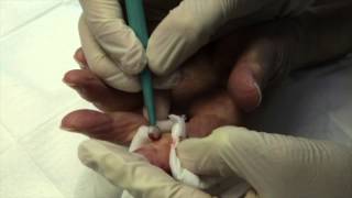 How to remove a Pyogenic Granuloma using surgery [upl. by Ynatterb]