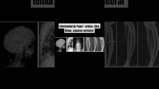 ENFERMEDAD DE PAGET CRÁNEO TIBIA FÉMUR COLUMNA VERTEBRAL  PELVIS [upl. by Jonette]