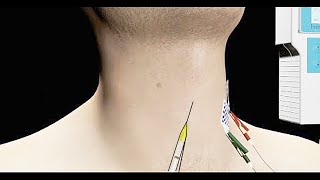 Spasmodic Dysphonia Treated with EMG Guided Botox Injection [upl. by Assenab]